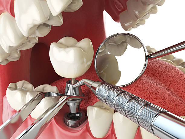 Best Lost Filling or Crown Replacement in Bellefonte, PA